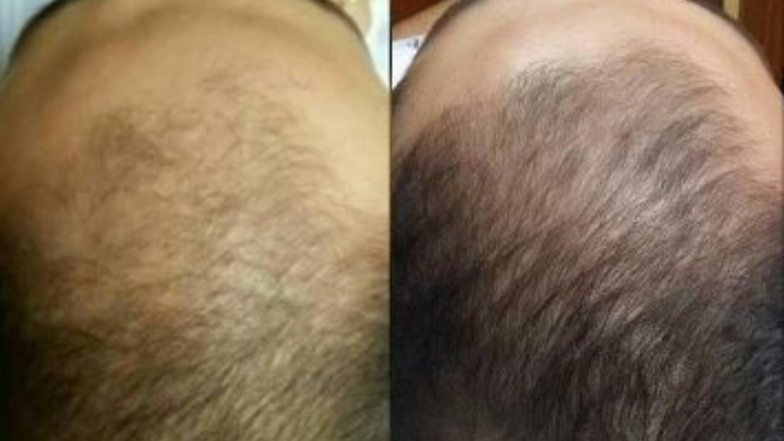 Rejuvenescimento e Crescimento Pró-Fios