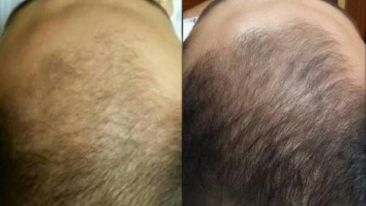 Rejuvenescimento e Crescimento Pró-Fios